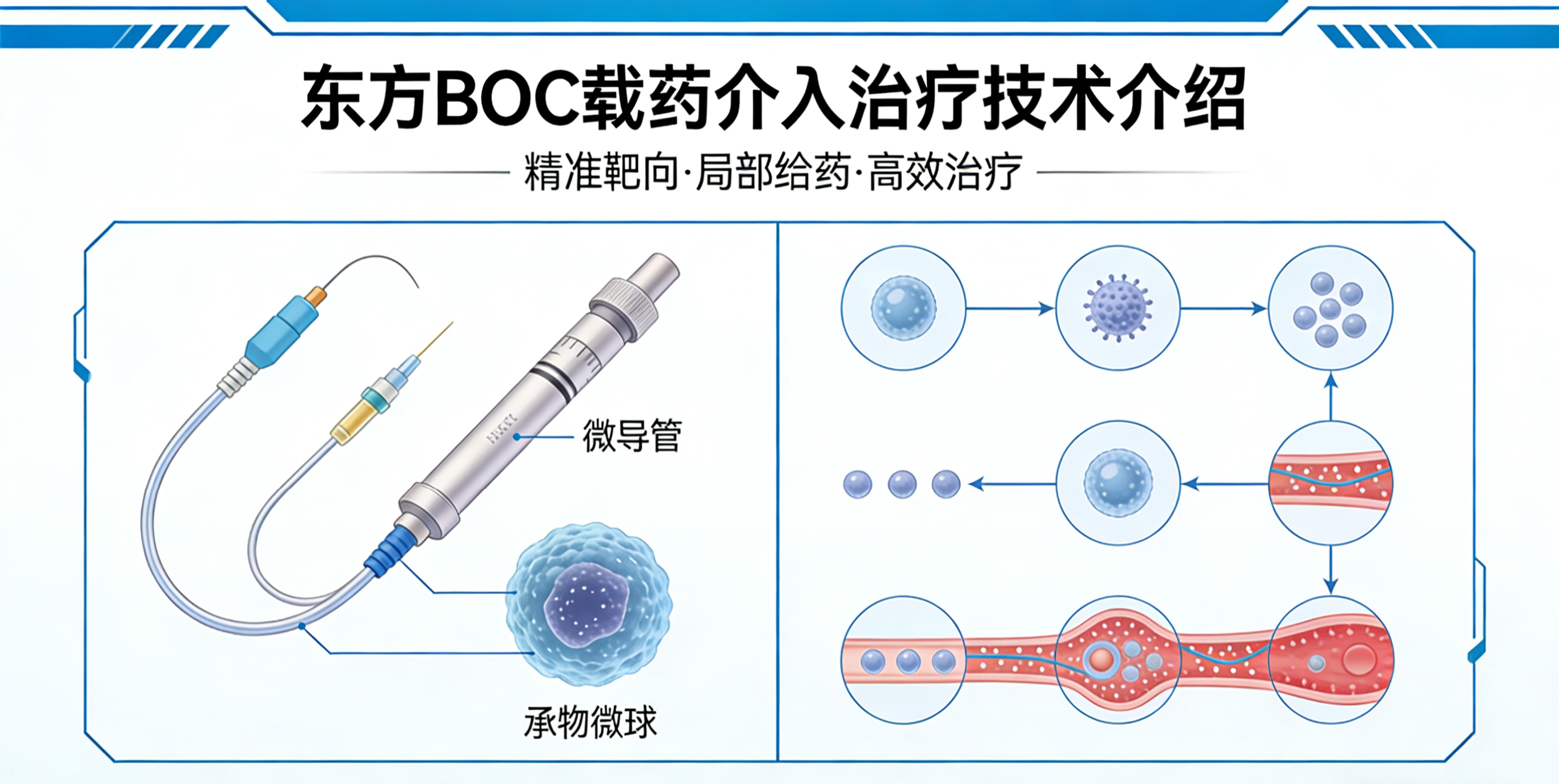 东方BOC 载药介入治疗技术介绍