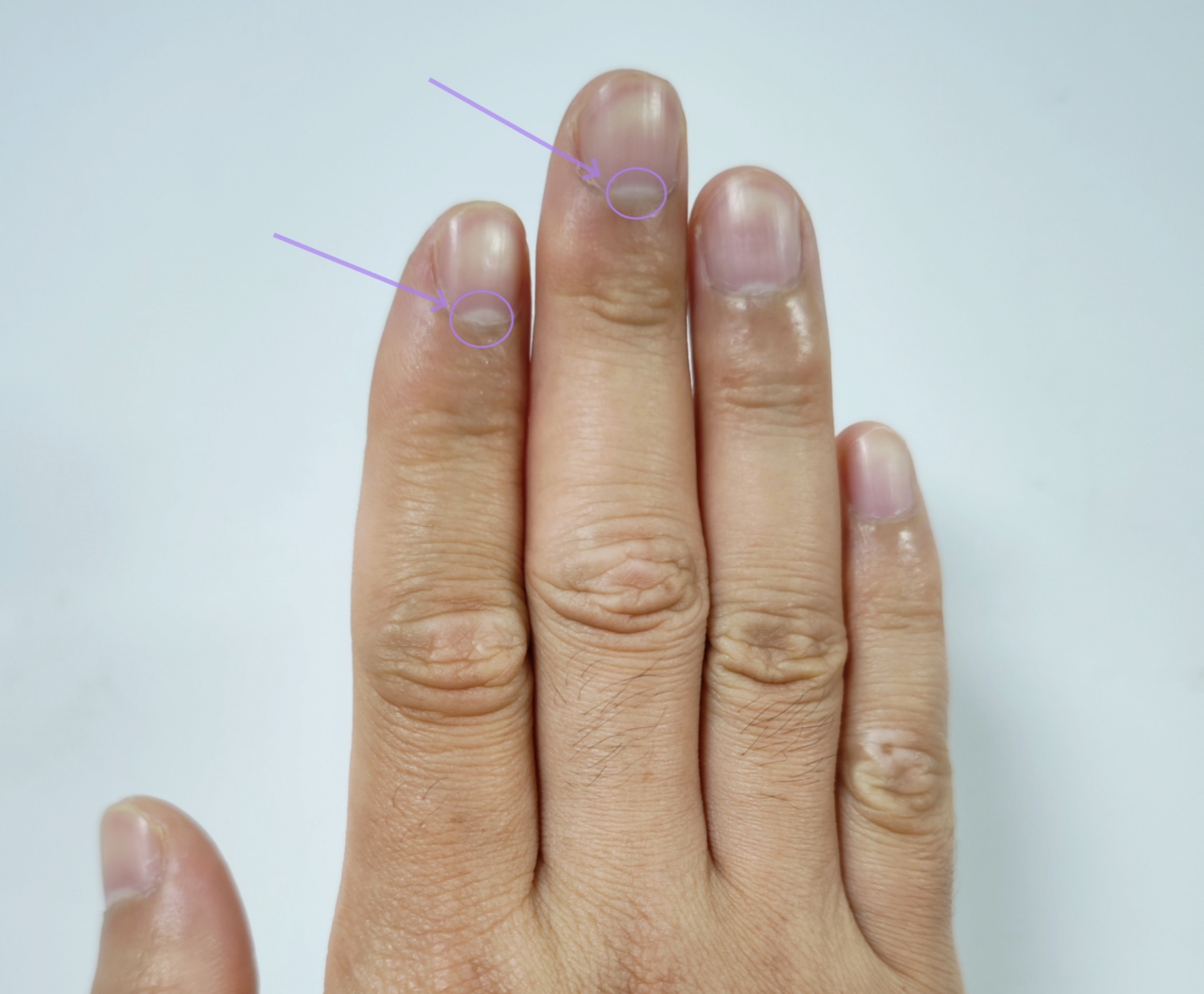 用指甲月牙的数量判断健康，科学吗？医生表示...