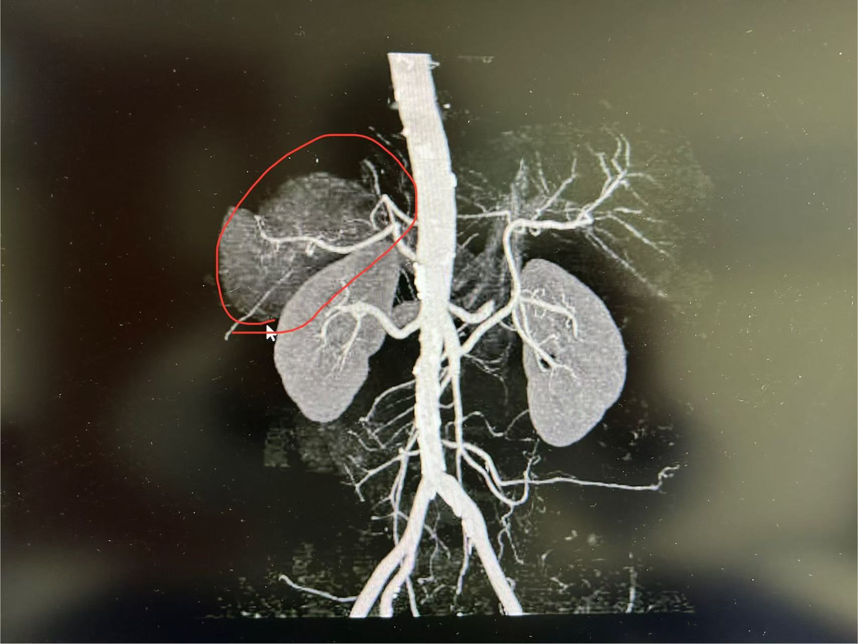 3年没体检，长出9cm肿瘤！医生提醒：警惕“沉默杀手”！