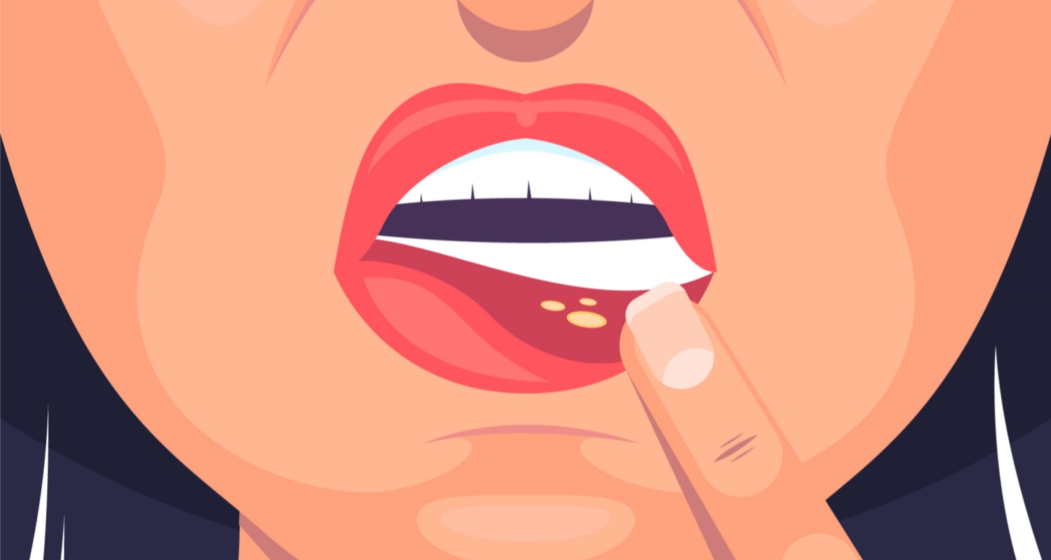 口腔溃疡，只会用消炎药？中医：这样“灭火”更科学